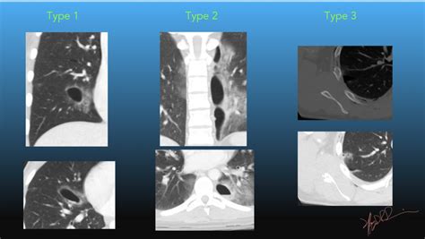 Multiple lung parenchymal abnormalities: Don’t panic, let's be .